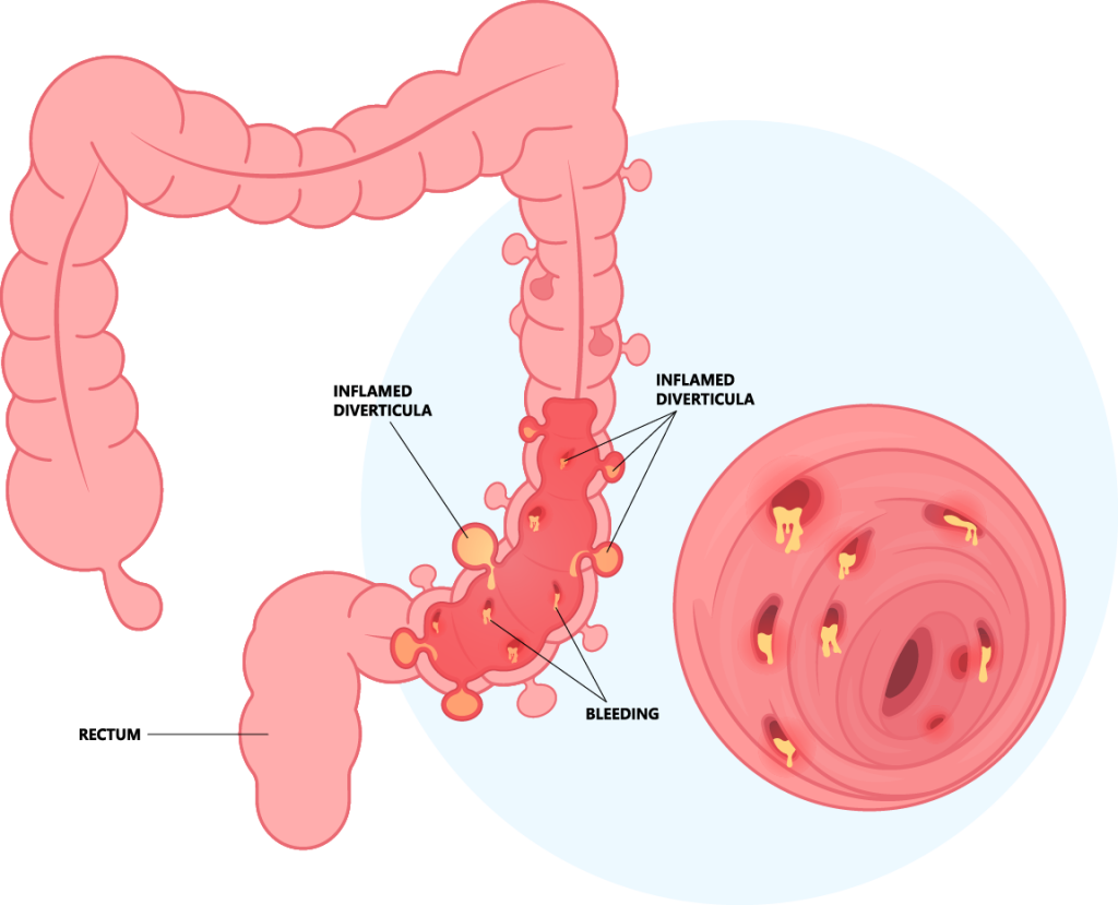 Diverticulitis