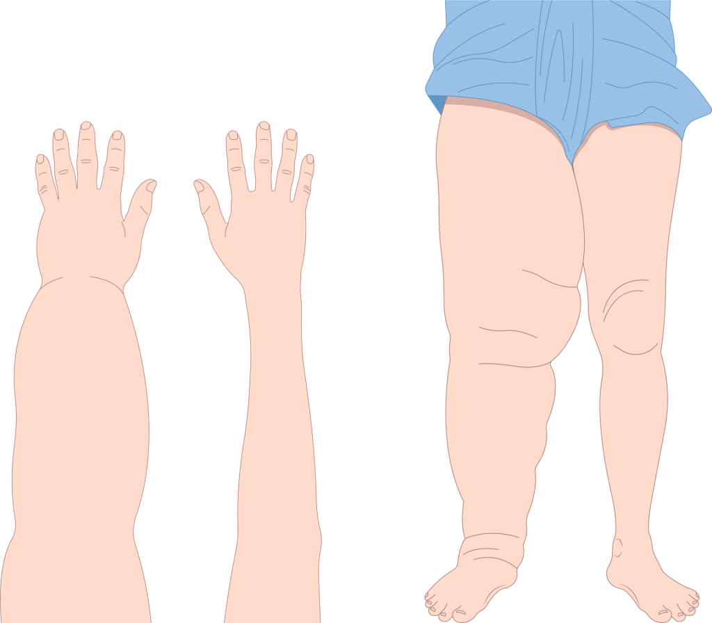 Lymphedema
