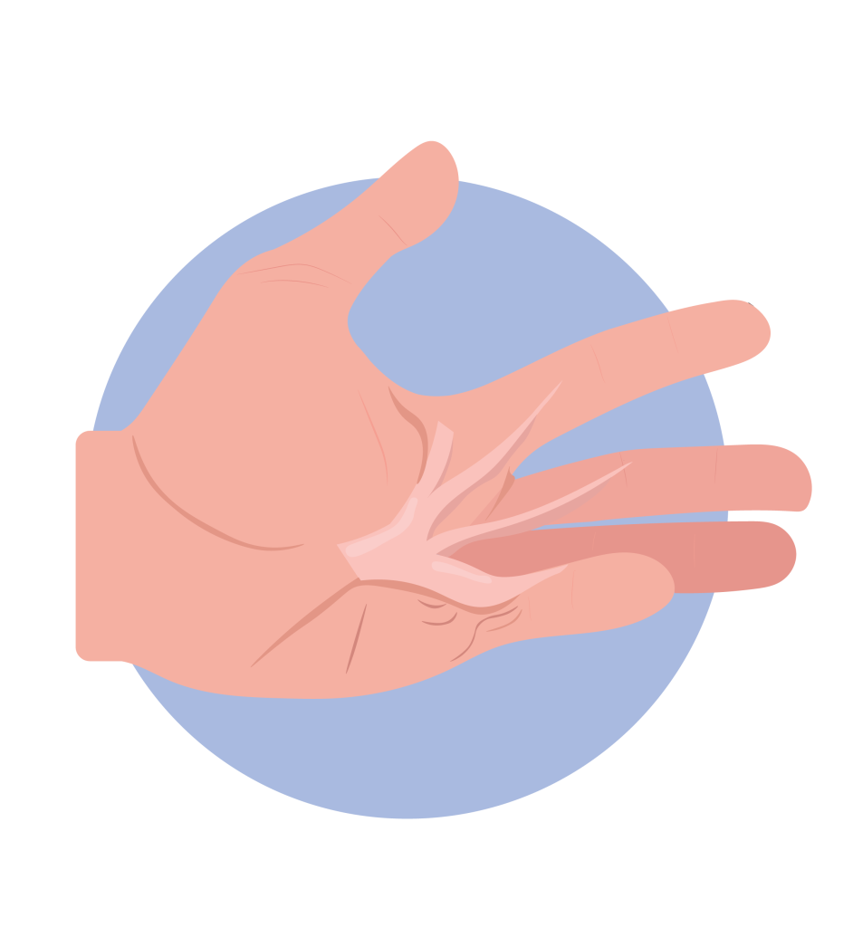 Dupuytren's Contracture