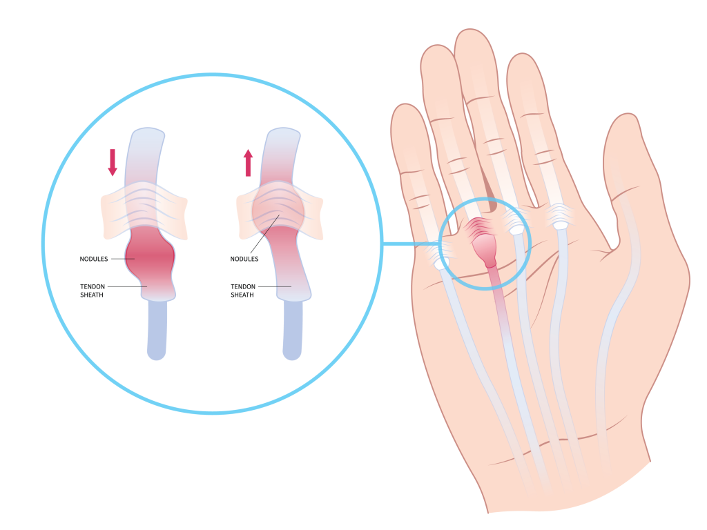 Dupuytren's Contracture