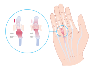 Dupuytren's Contracture