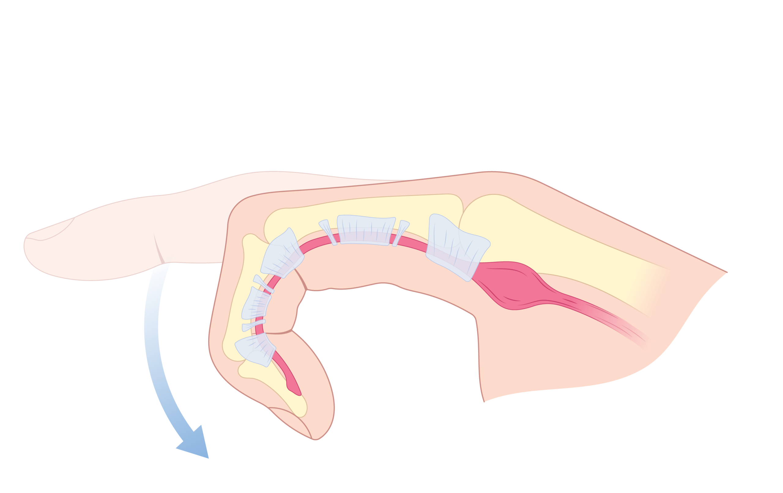 Dupuytren's Contracture
