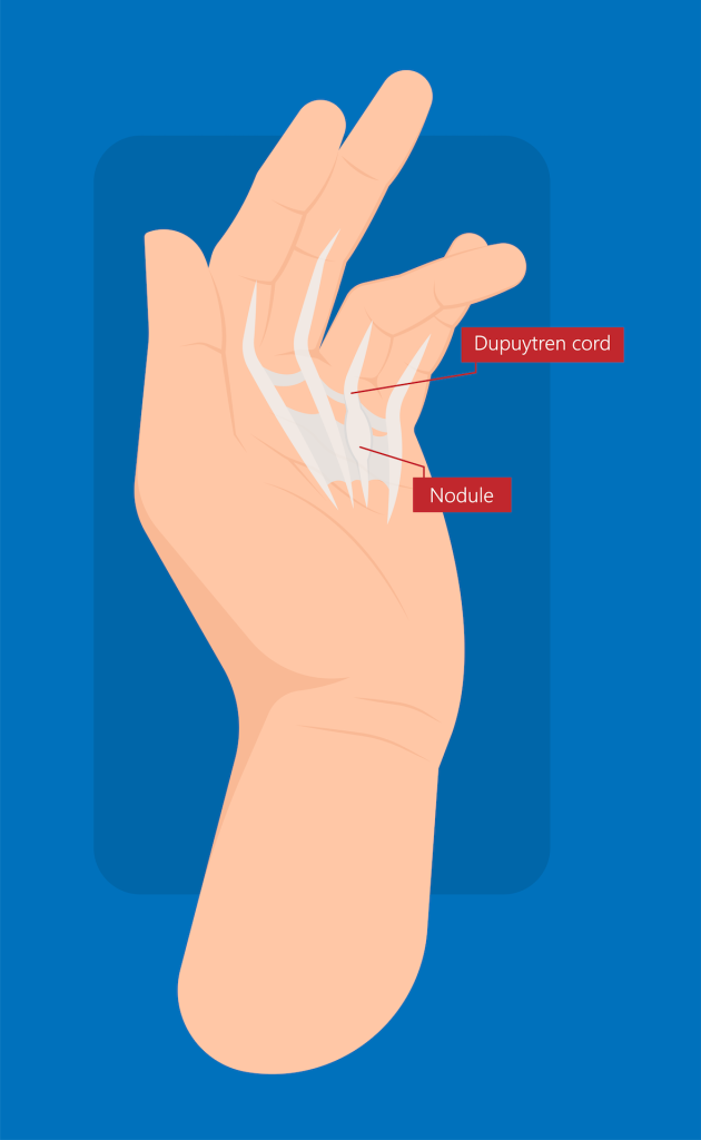 Dupuytren's Contracture